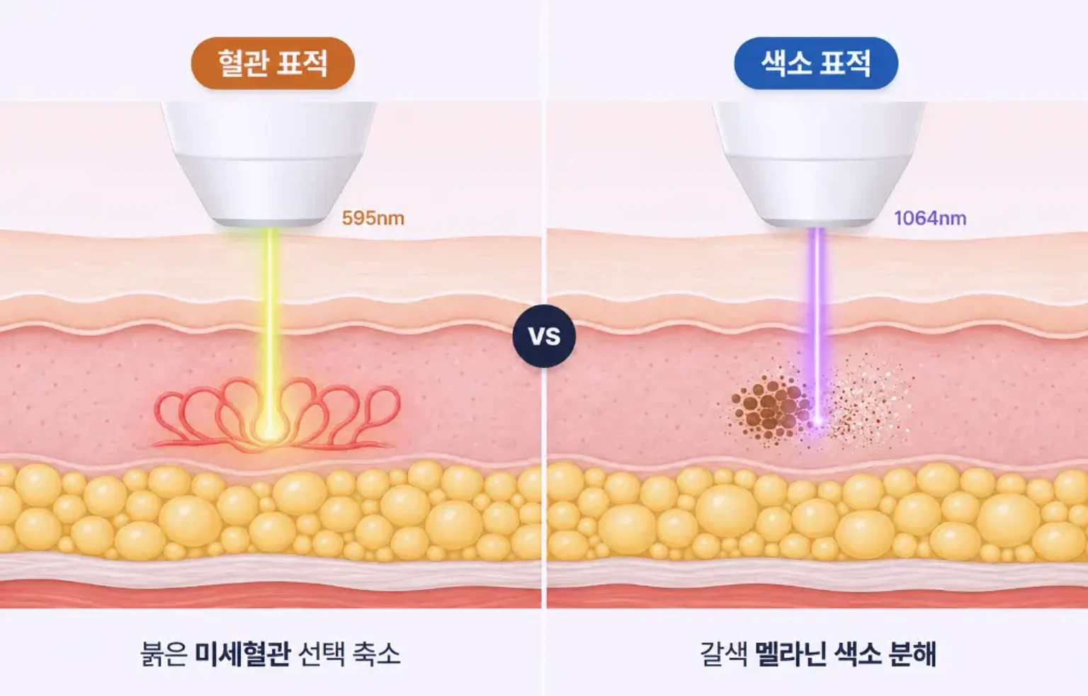 붉은 흉터의 확장된 미세혈관과 갈색 멜라닌 색소에 각각 흡수되는 레이저 파장 비교 개념도