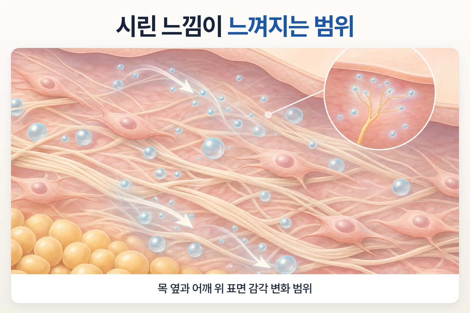 목 옆과 어깨 위 표면 감각 신경 가지와 시린 느낌 범위를 나타낸 분포 개념도