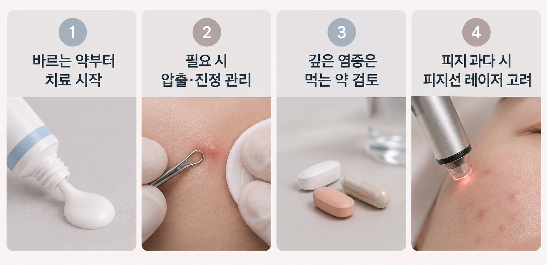 청소년 여드름 상태에 따른 치료 방법