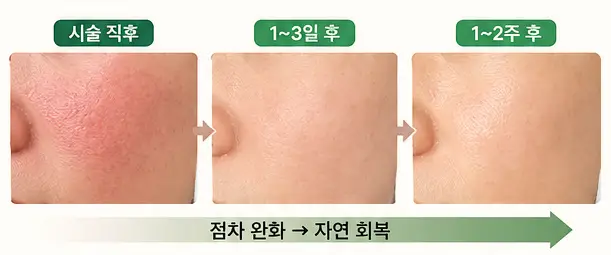 피코토닝 후 붉은기와 피부 자극이 점차 완화되는 정상 회복 과정