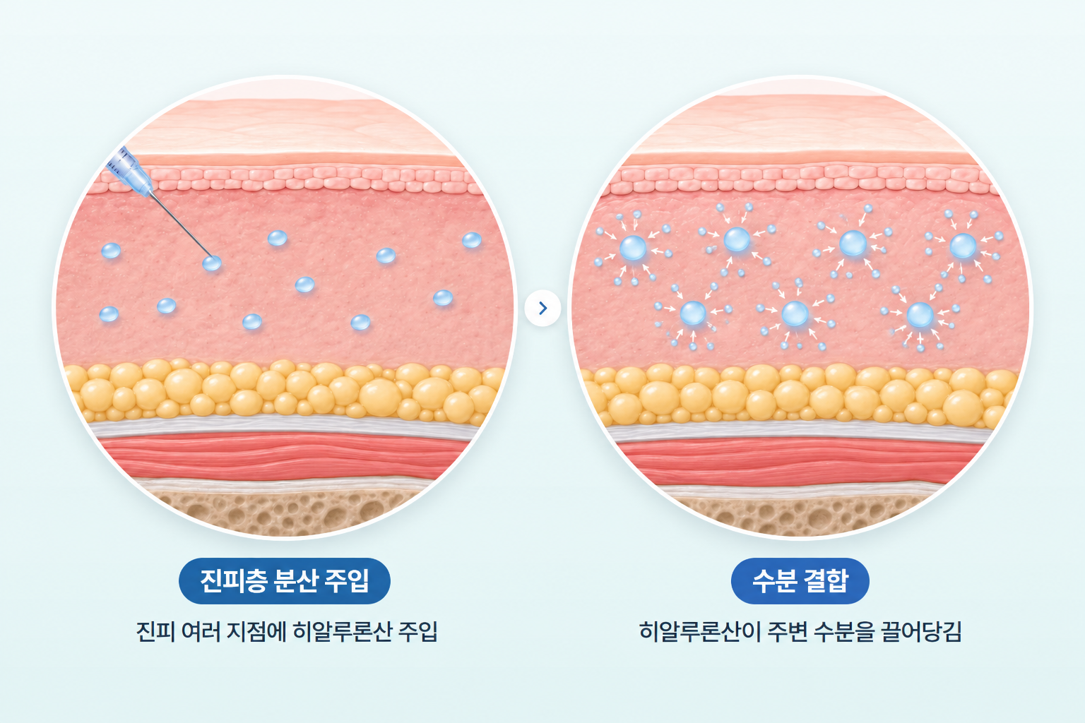 물광주사로 히알루론산을 진피층 여러 지점에 미세하게 주입하고 주변 수분을 끌어당겨 유지하는 과정