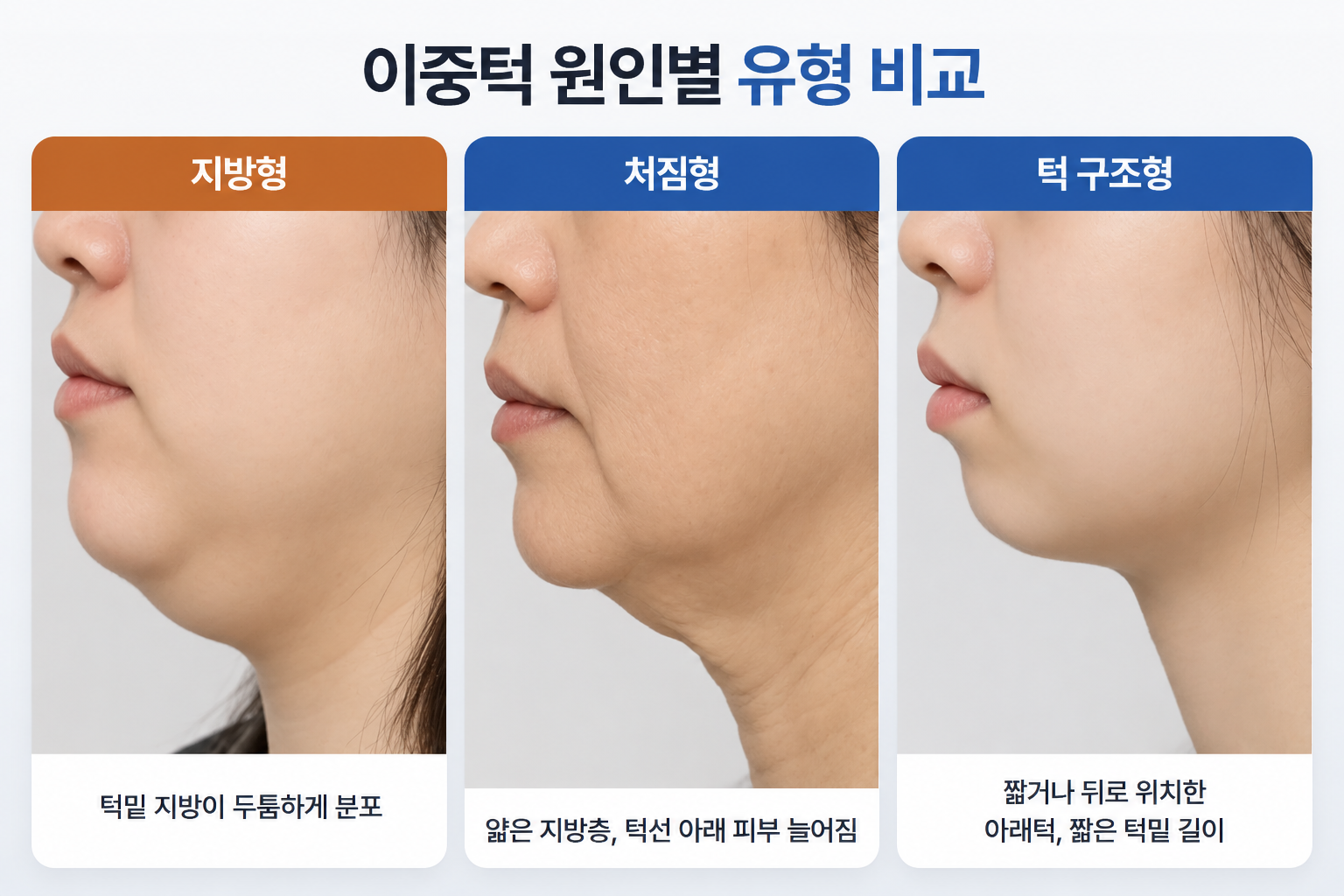 이중턱 주사 효과에 영향을 주는 지방형 처짐형 턱 구조형의 턱밑 특징
