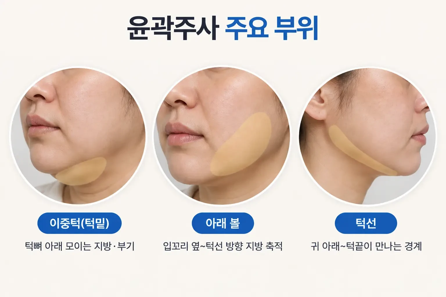 이중턱, 아래 볼, 턱선 주변에 피하지방이 모이는 위치를 부위별로 나눈 하안면 비교 사진