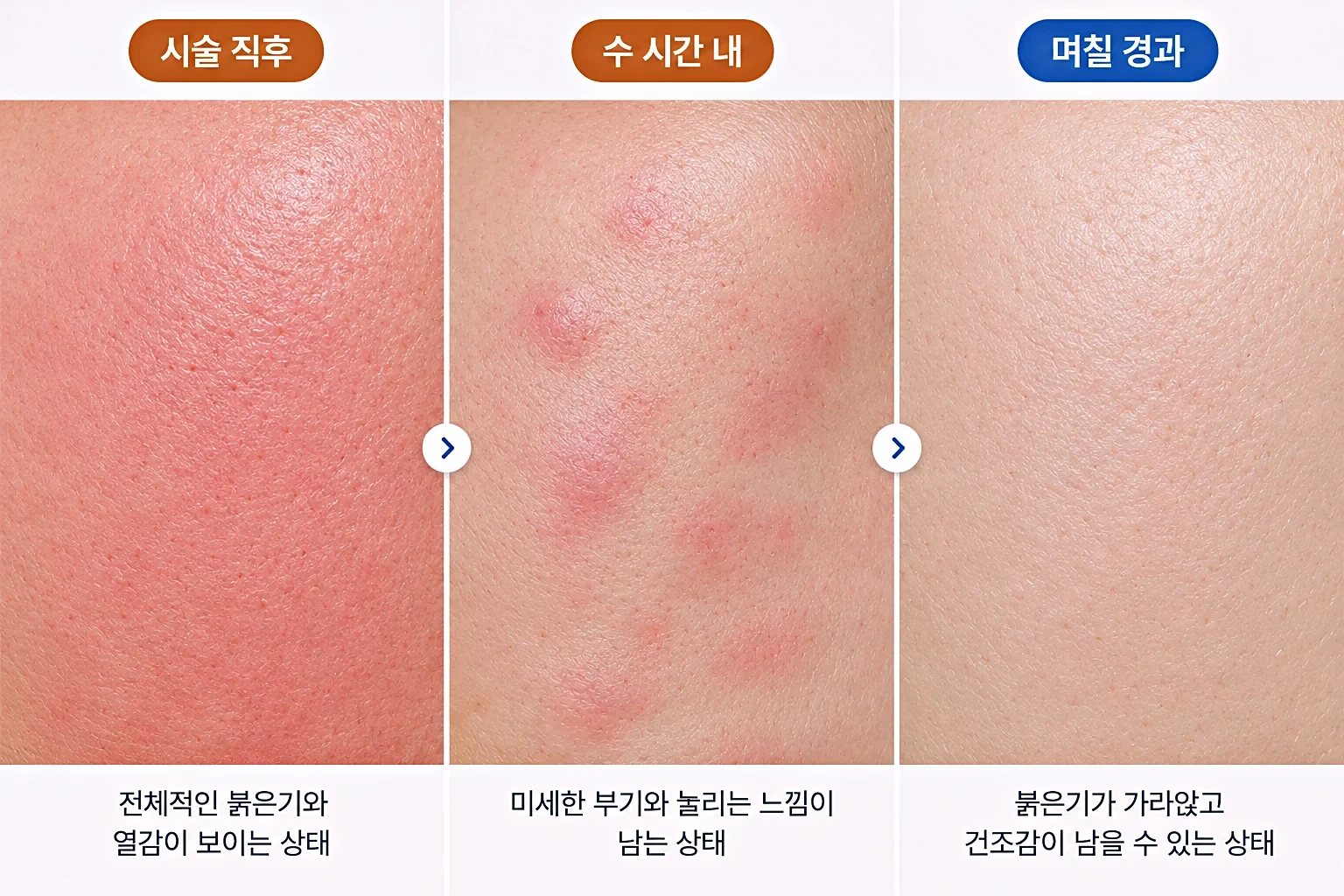 고주파 시술 직후 붉은기와 미세 부기가 가라앉는 경과를 단계별로 비교한 일러스트
