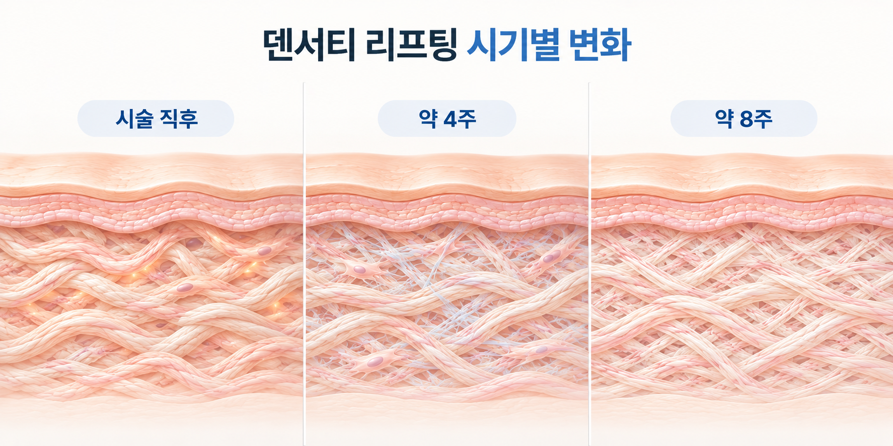 덴서티 리프팅 후 시술 직후부터 약 4주와 8주까지 콜라겐 재구성 변화