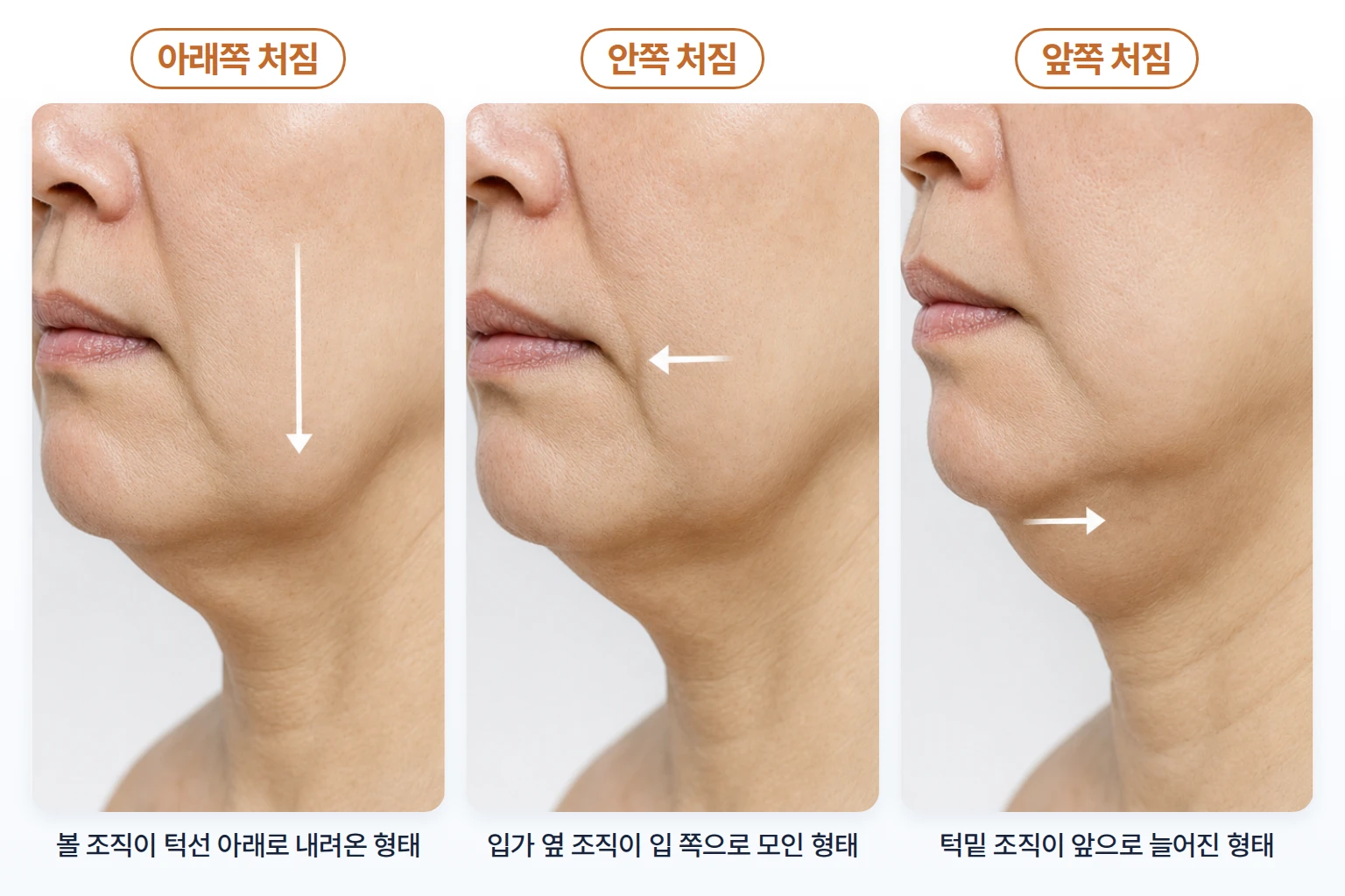 볼과 턱선 조직이 아래쪽, 안쪽, 앞쪽으로 처지는 방향을 화살표로 나타낸 하안면 부위 비교 사진