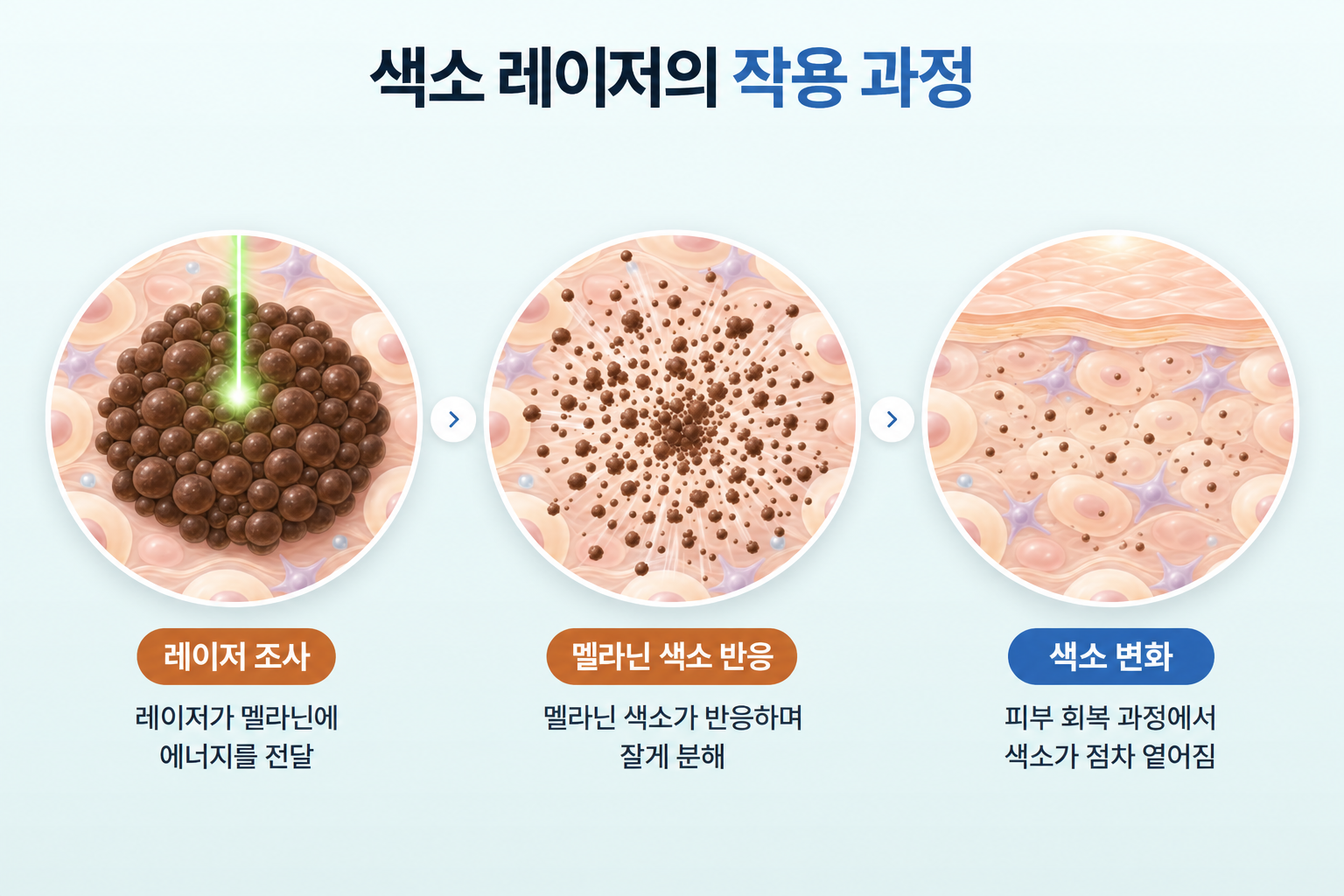 레이저 에너지가 멜라닌 색소에 전달되고 색소 덩어리가 작은 입자로 분해된 뒤 피부 회복 과정에서 색소가 점차 옅어지는 3단계