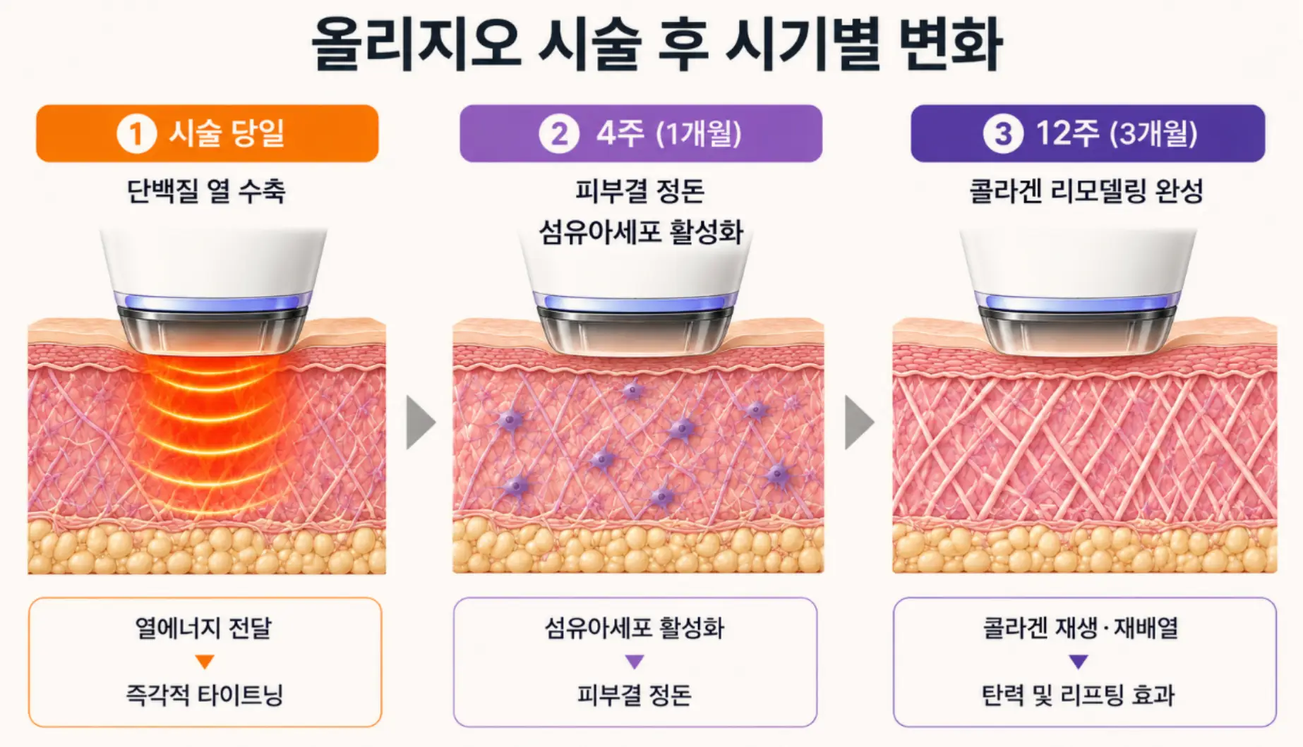 부산 올리지오 시술 후 당일 열 수축부터 리모델링 완성까지 시기별 피부 변화 단면도
