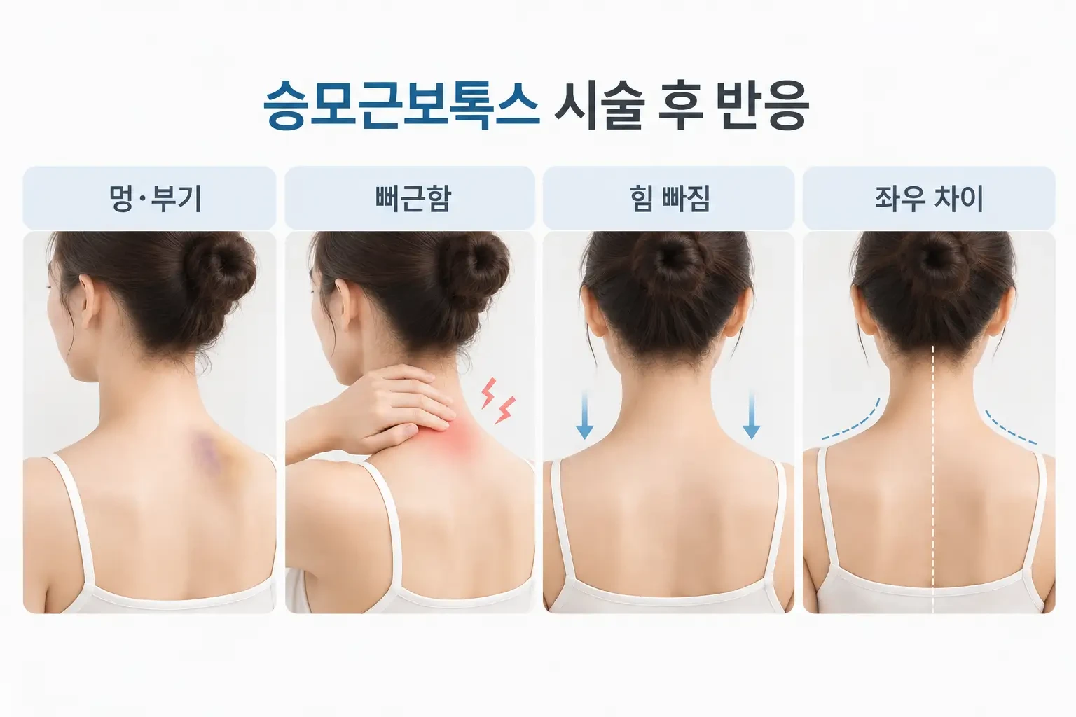 승모근보톡스 시술 후 멍·부기, 뻐근함, 힘 빠짐, 좌우 어깨선 차이 비교 이미지