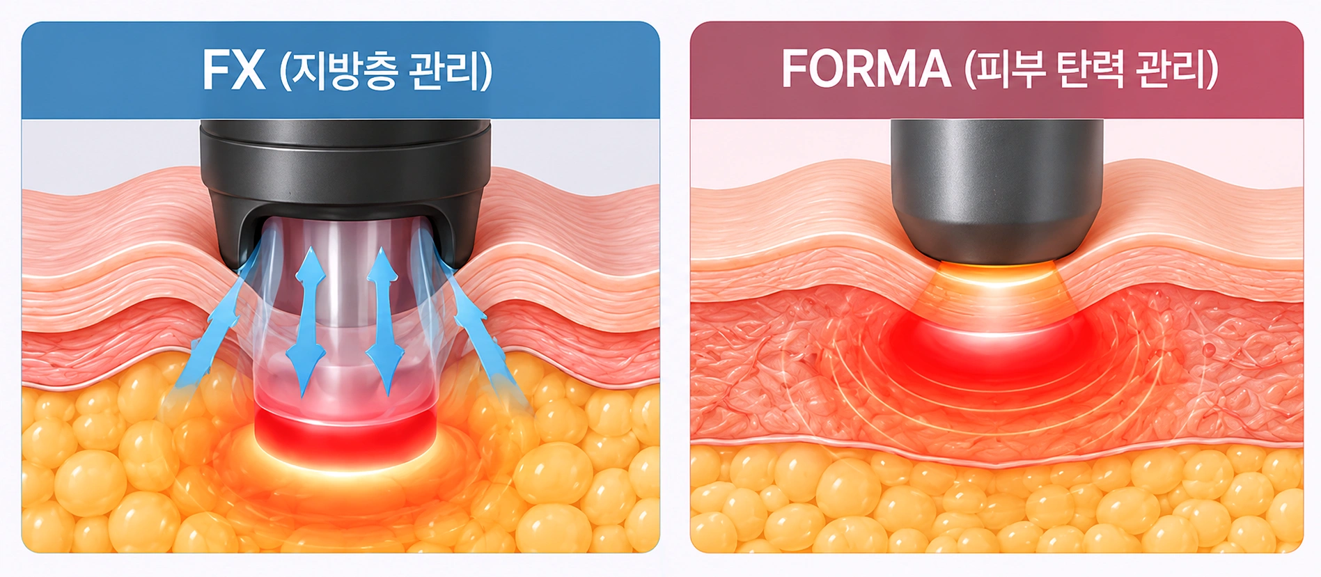FX는 지방층, FORMA는 진피층에 작용하는 인모드 리프팅 원리