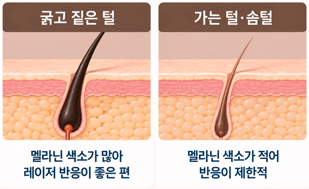 굵고 짙은 털과 가는 털·솜털의 멜라닌 색소량 및 레이저 반응 차이를 비교한 피부 단면도