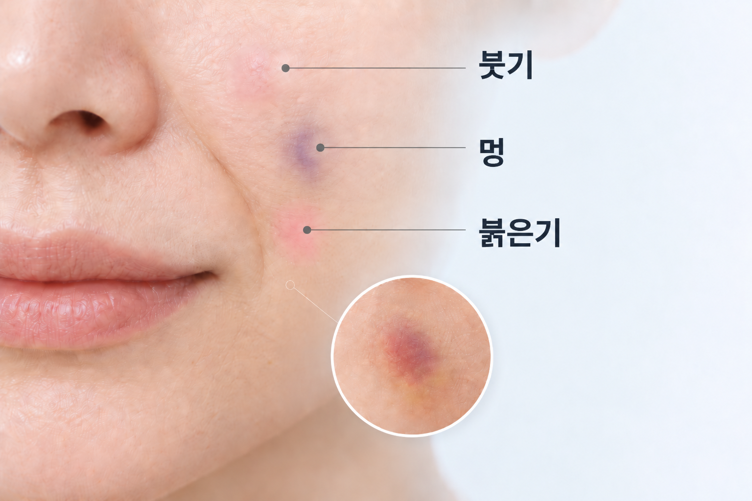 팔자 주름 필러 후 붓기 멍 붉은기 반응