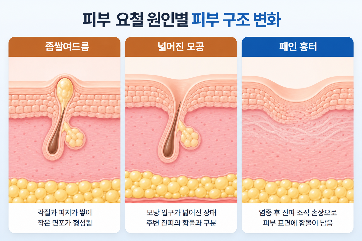 피부 요철 원인별 모공 막힘으로 형성된 좁쌀여드름, 모공 입구 확장, 진피 조직 손상에 따른 패인 흉터의 단면 구조 비교