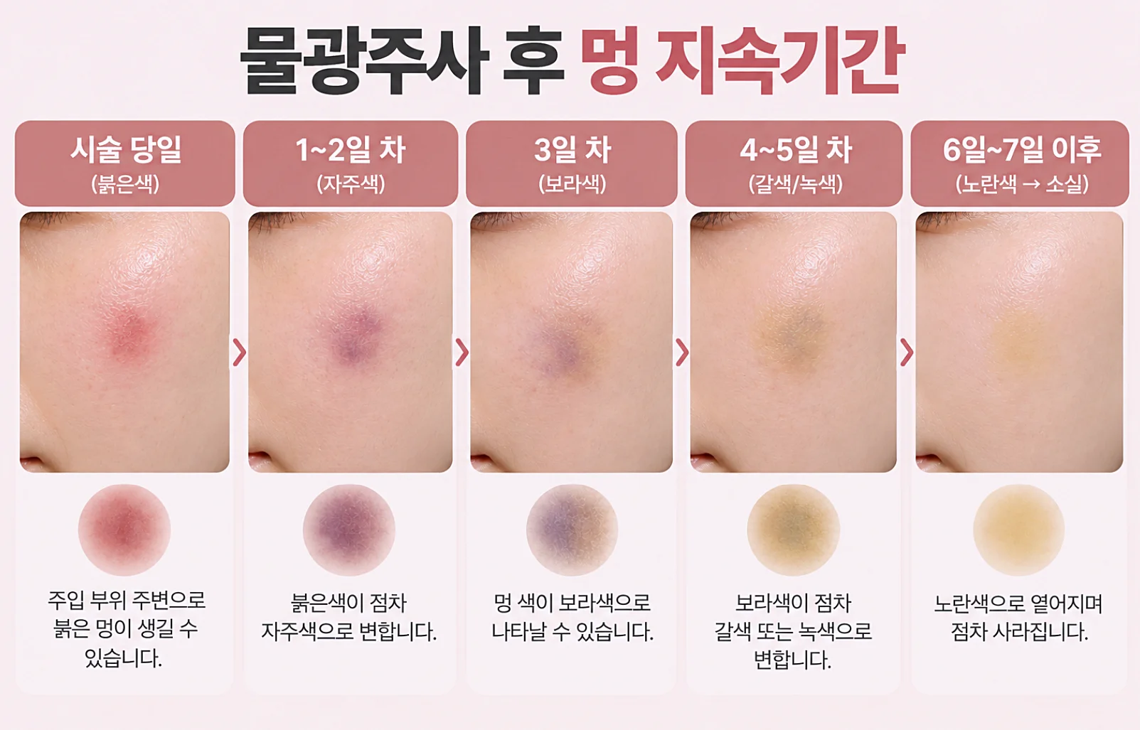 물광주사 후 멍 지속기간 - 시술당일 1일차부터 -7일이후까지