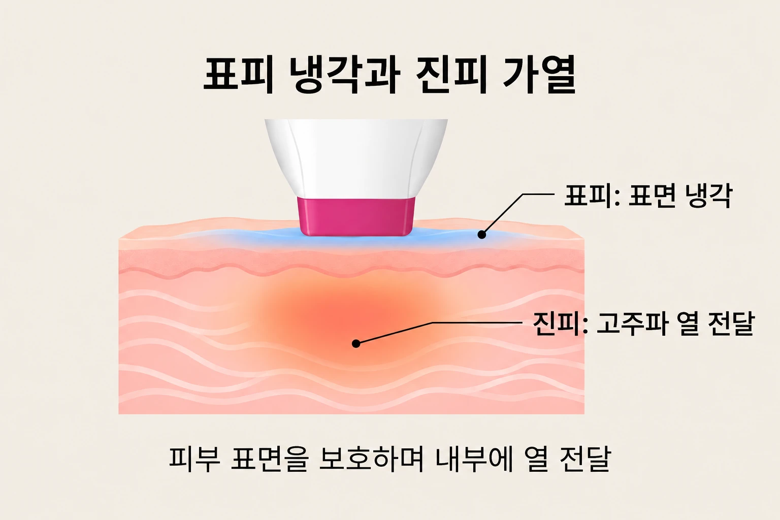 써마지 팁의 표면 냉각과 진피 내부 고주파 열 전달을 나타낸 단면도