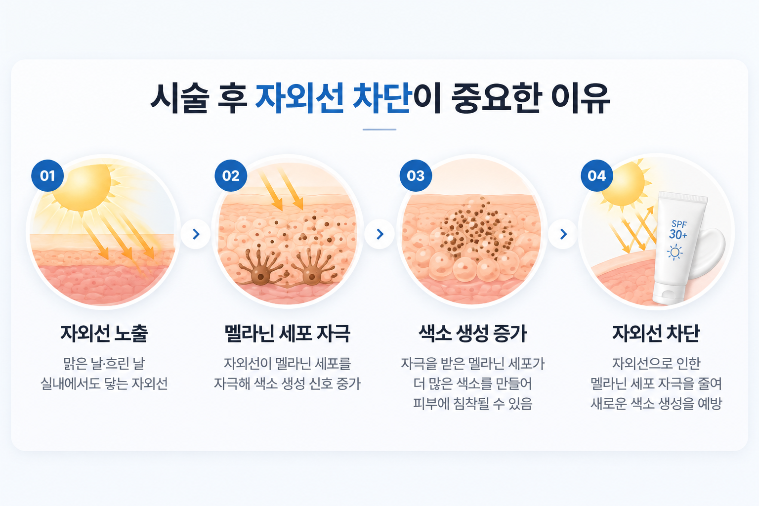 자외선 노출로 멜라닌세포가 자극되고 피부 색소 생성이 증가하는 과정과 자외선 차단을 통한 추가 색소침착 예방 원리