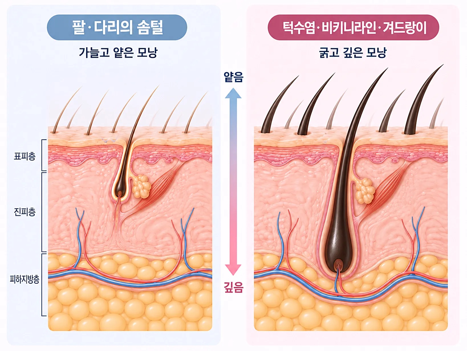 털의 굵기와 모낭 진피 침투 깊이 - 팔다리 솜털과 턱수염 비키니라인 겨드랑이 굵은 털