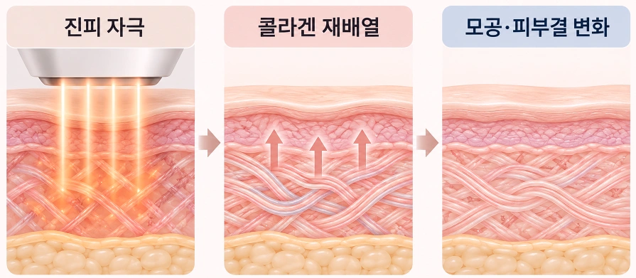 피코슈어 에너지가 진피를 자극한 뒤 콜라겐 재배열을 유도해 모공과 피부결 변화를 기대하는 과정을 나타낸 피부 단면 모식도