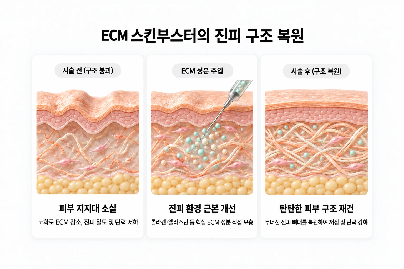 진피 지지 구조의 붕괴, ECM 성분 주입, 구조 복원을 보여주는 3단계 개념도