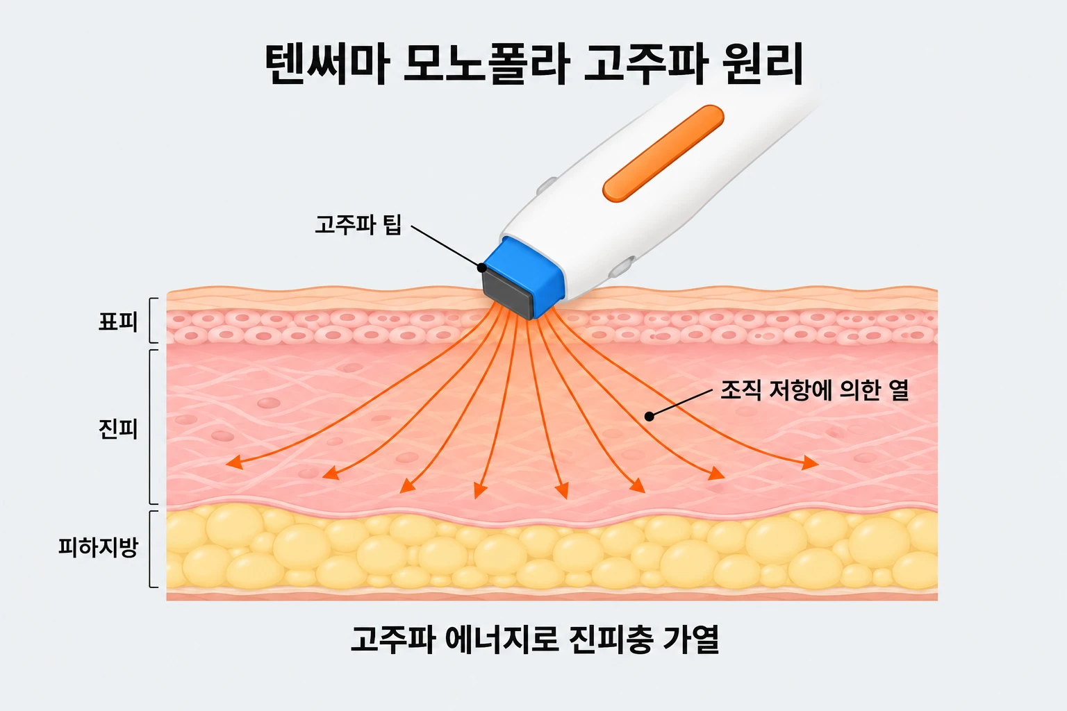 텐써마 핸드피스가 피부에 접촉하고, 진피층으로 퍼지는 고주파 에너지와 조직 저항에 의한 열을 나타낸 피부 단면도