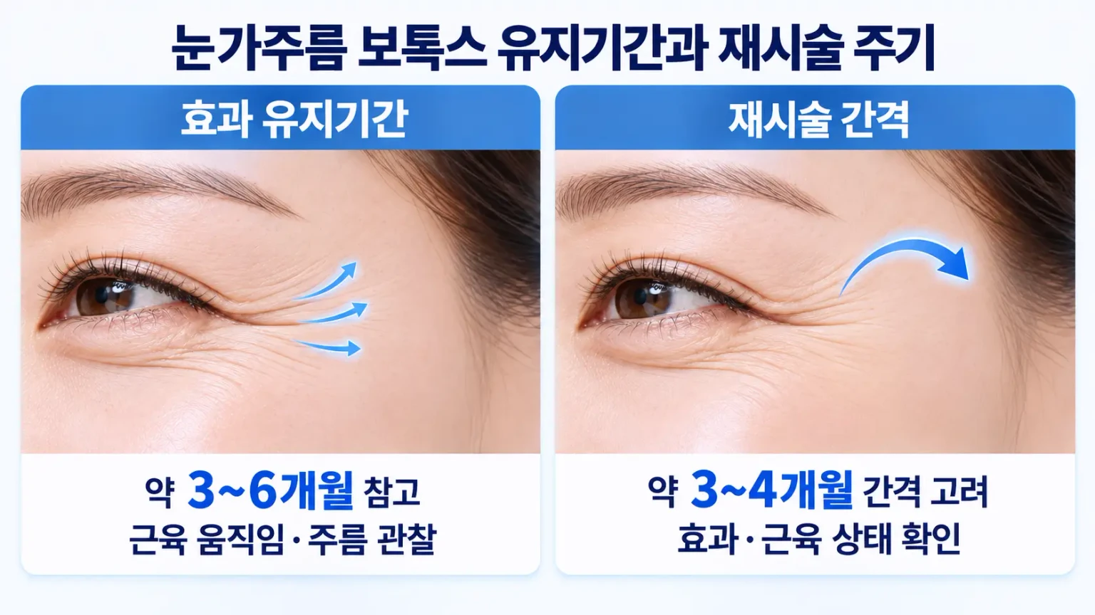 눈가주름 보톡스 유지기간과 재시술 주기를 비교한 의료정보 이미지