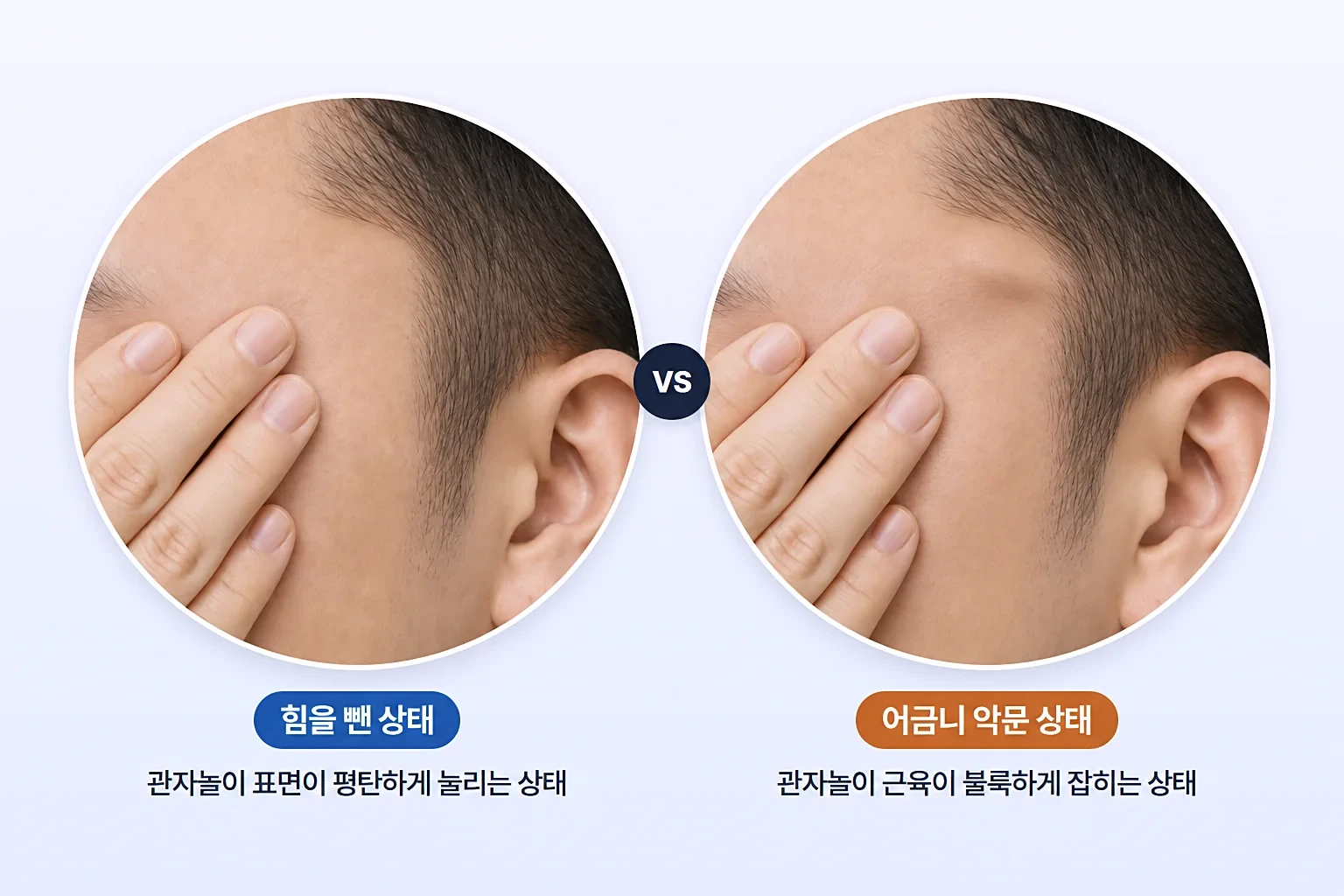 손바닥을 댄 상태에서 이완과 어금니 악물기 시 관자놀이 측두근 변화를 비교한 크롭 사진