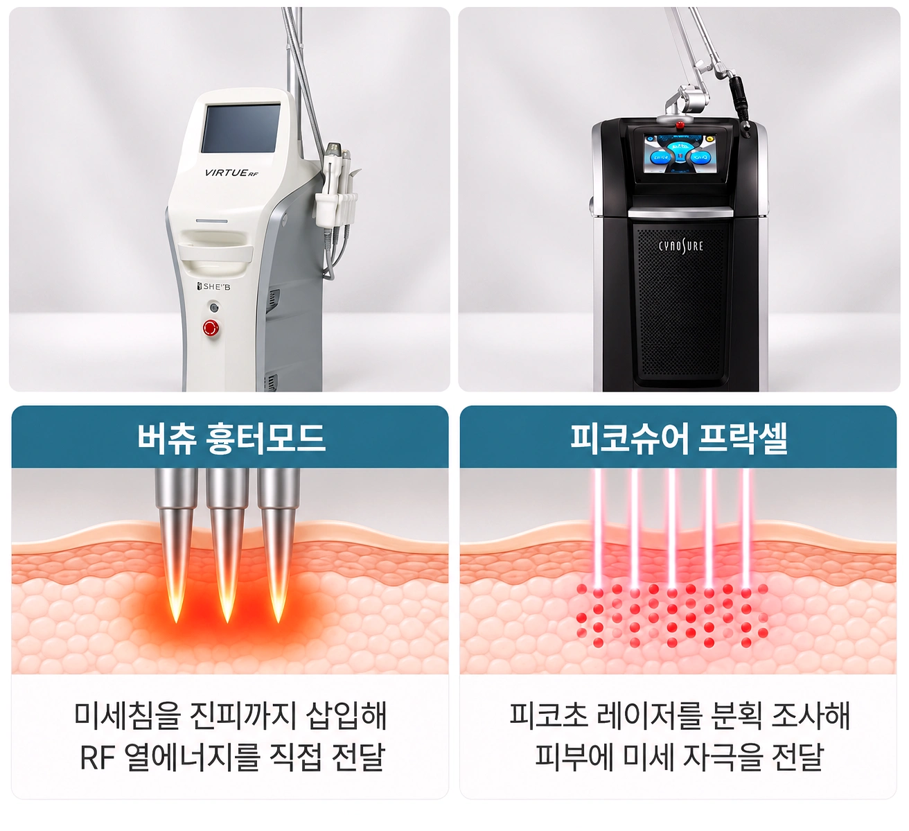 버츄 흉터모드와 피코슈어 프락셀의 패인 흉터 치료 원리