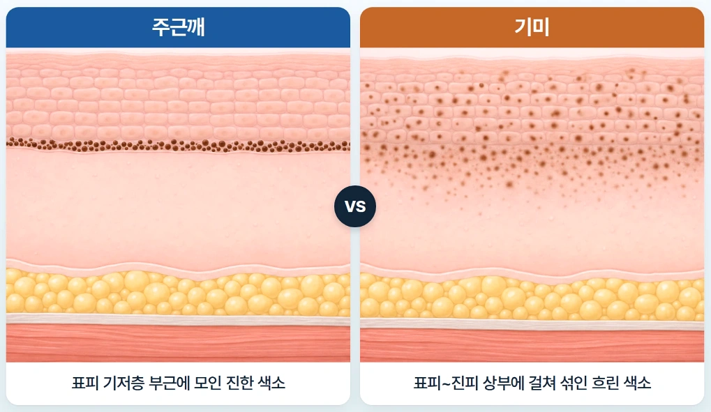 주근깨는 표피 기저층에 색소가 집중되고 기미는 표피와 진피 상부에 색소가 넓게 분포하는 차이를 비교한 피부 단면도