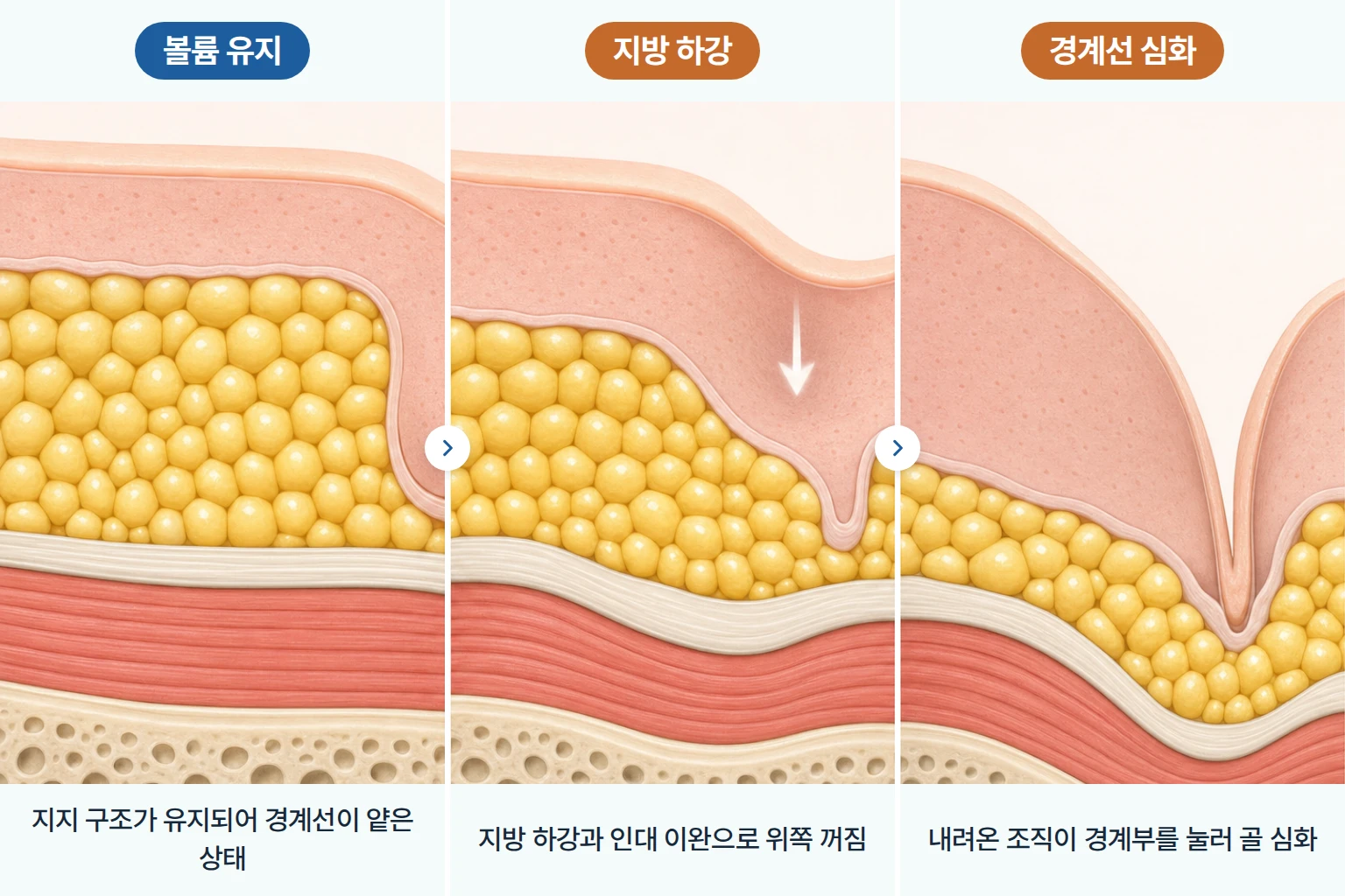 중안면 지방 하강과 지지 구조 꺼짐으로 팔자 경계선이 깊어지는 단계별 단면 일러스트