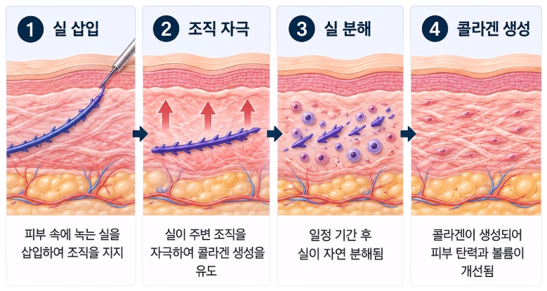 실 삽입부터 조직 지지·콜라겐 생성까지 이어지는 팔자주름 실리프팅 원리