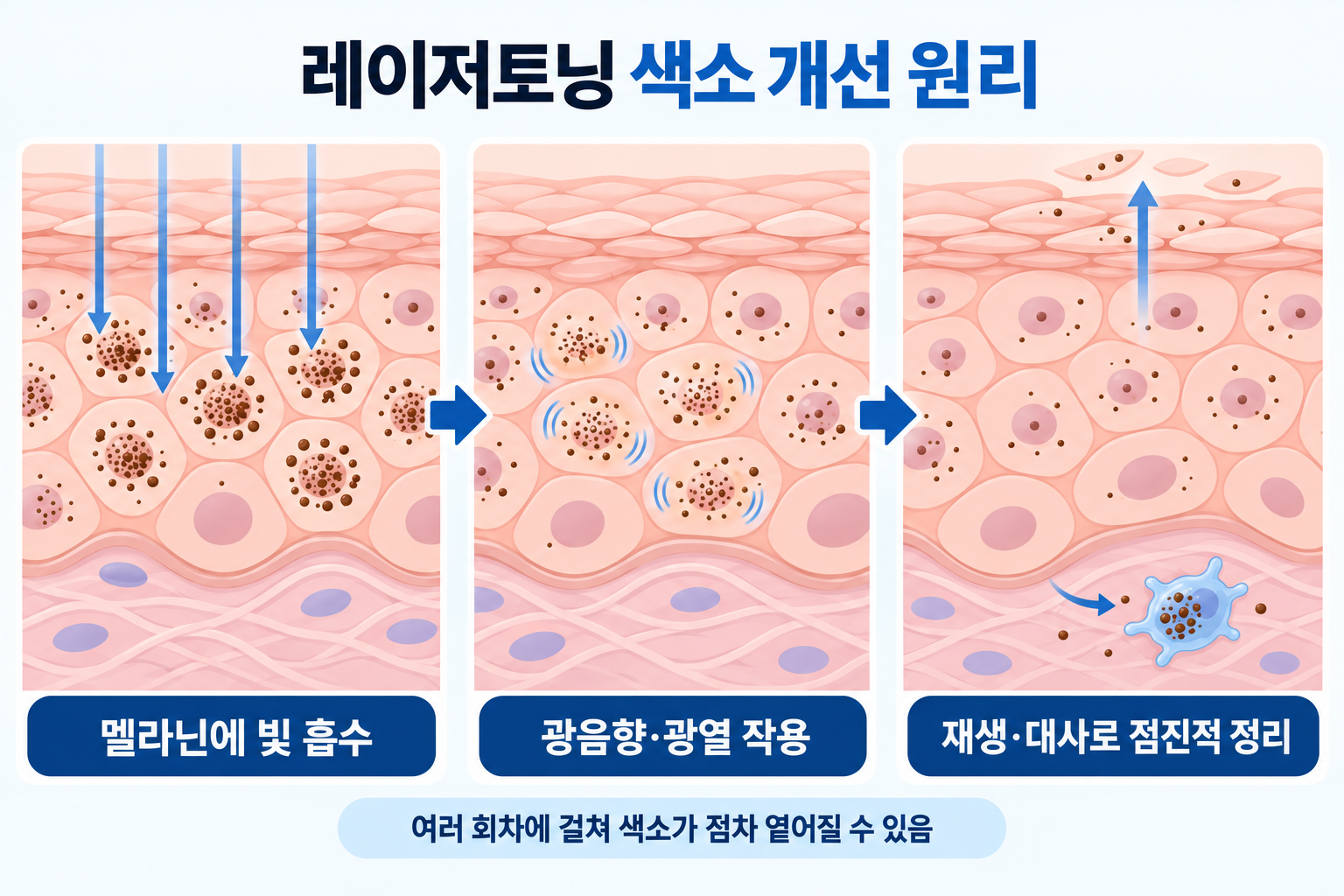 레이저토닝으로 멜라닌 색소에 광열 작용이 일어나는 원리를 나타낸 피부 단면도