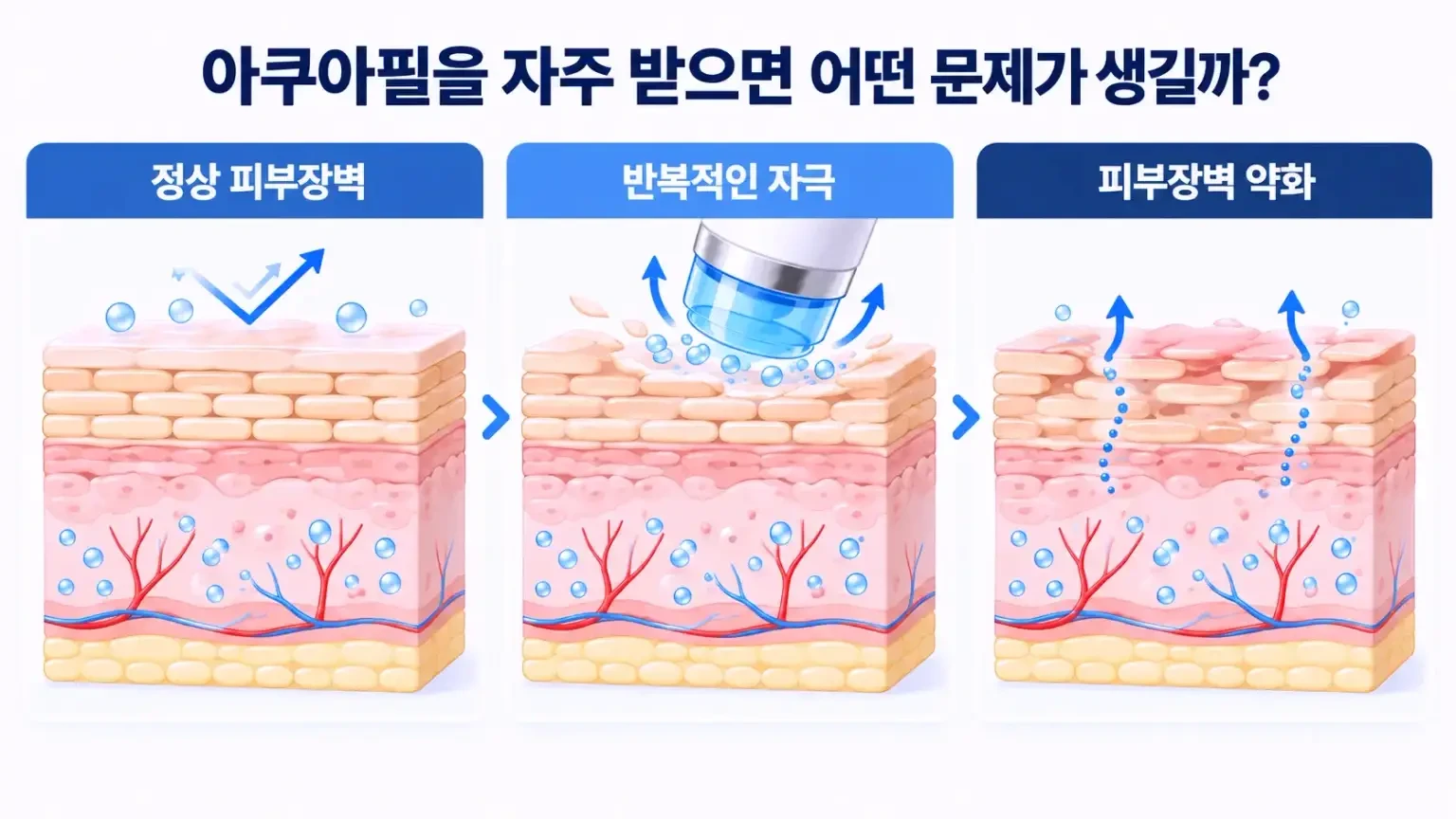 아쿠아필 잦은 시술로 인한 피부장벽 약화 가능성과 각질층 변화, 수분 손실 원리를 비교한 의료 인포그래픽