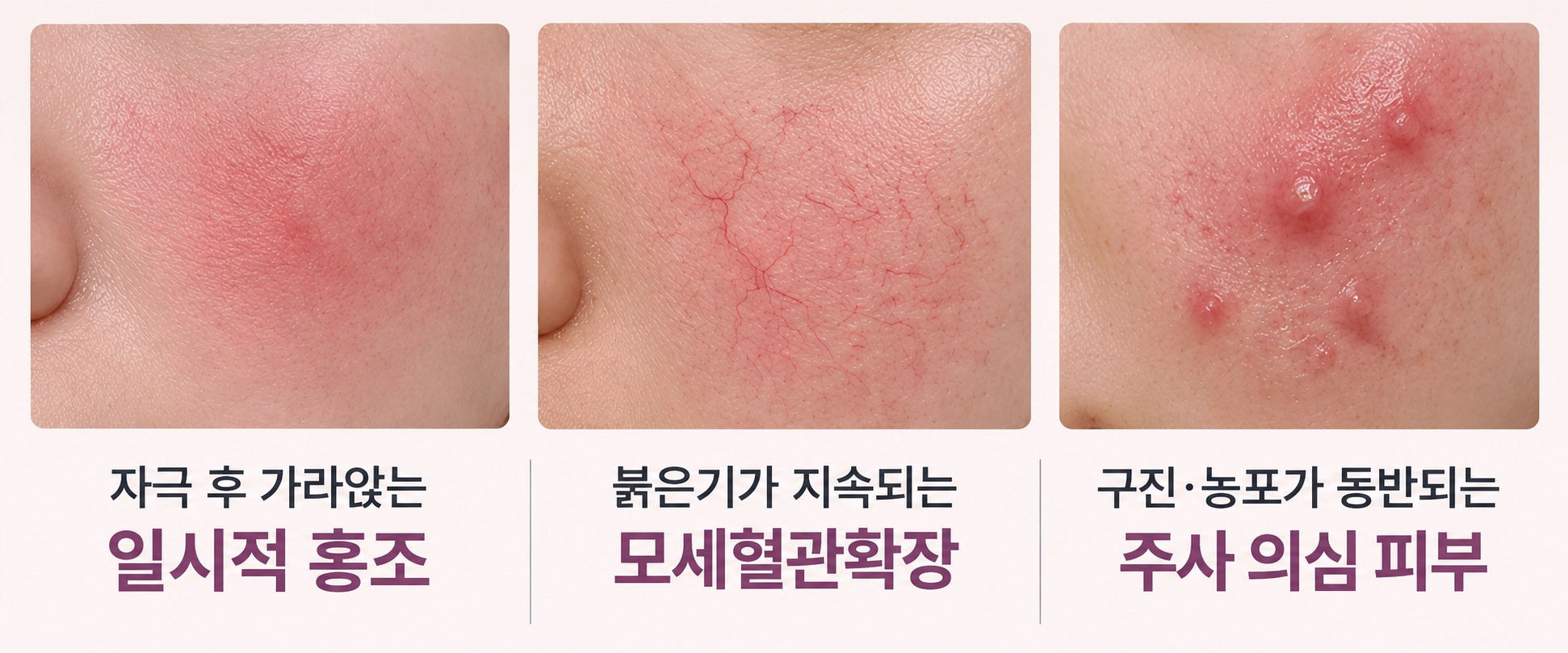 일시적 홍조·모세혈관확장·주사 의심 피부의 특징 비교