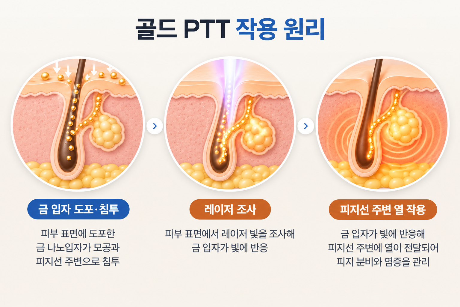 좁쌀여드름과 염증성 여드름 관리에 활용되는 골드 PTT의 금 나노입자 모공 침투, 레이저 조사, 피지선 주변 열 작용을 나타낸 3단계 치료 원리