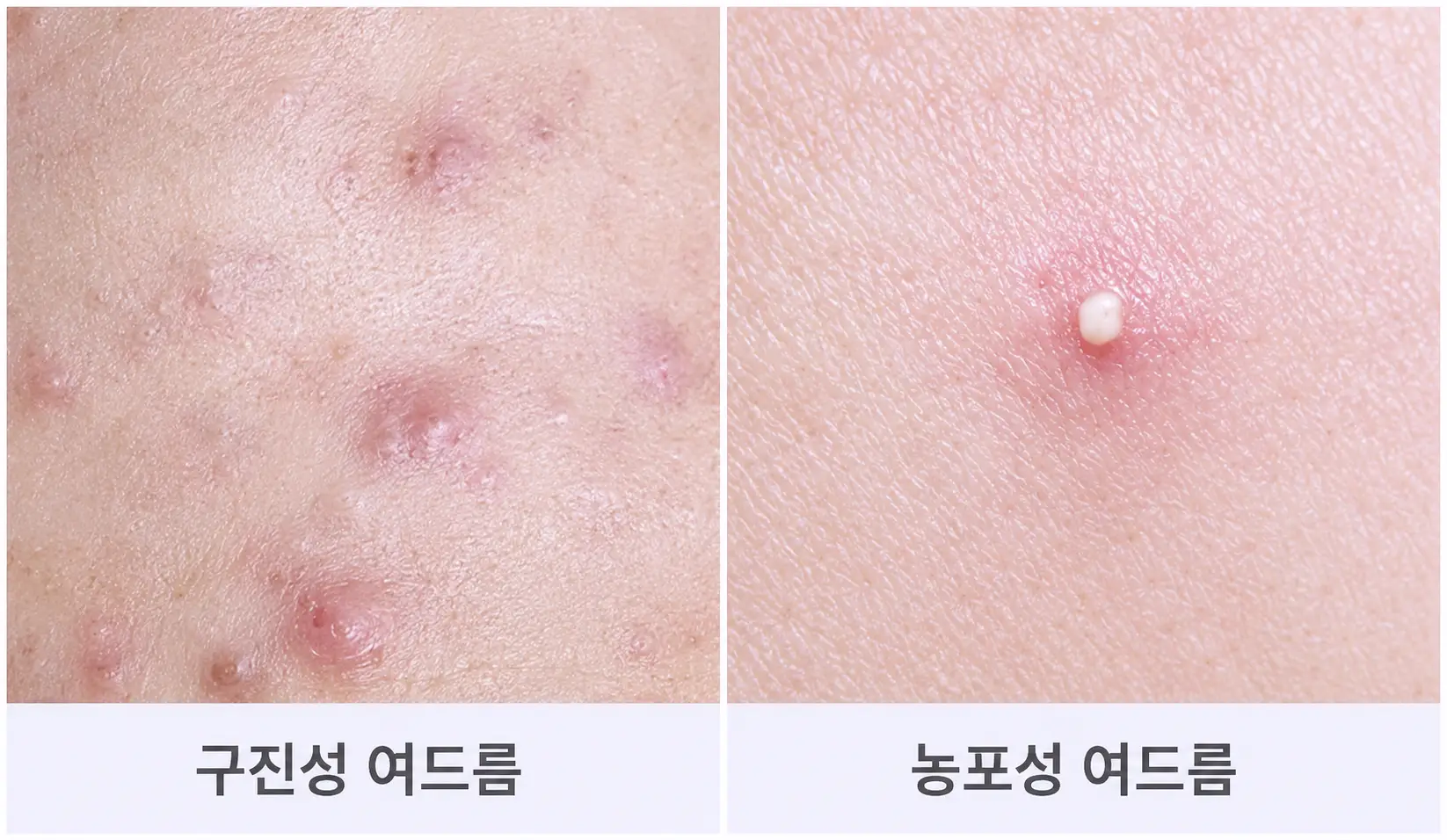 광명여드름치료 시 살펴보는 구진성 여드름과 농포성 여드름의 차이