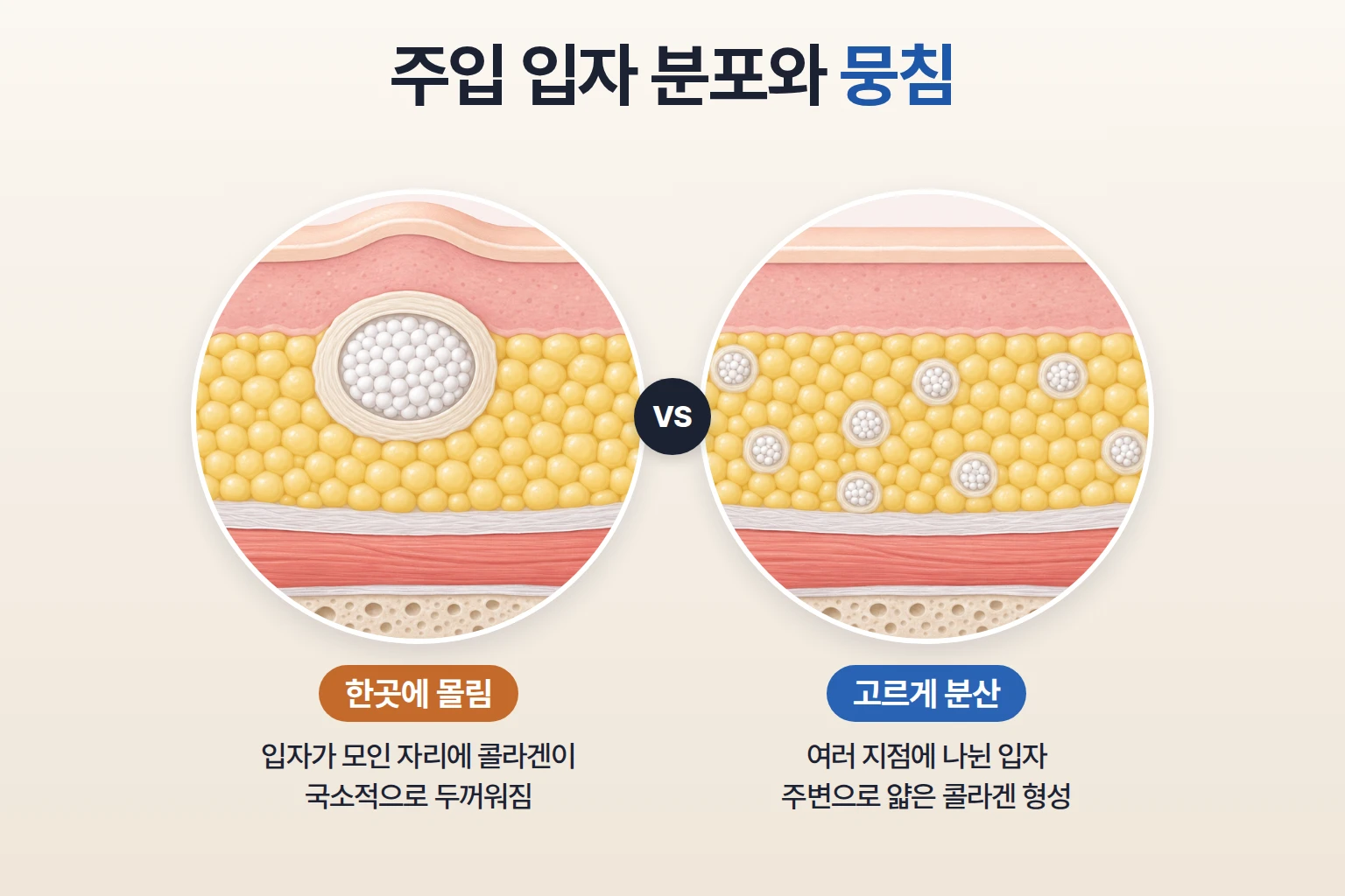 PDLLA 입자가 한곳에 몰린 피하층과 여러 지점에 고르게 퍼진 피하층을 나란히 비교한 단면도