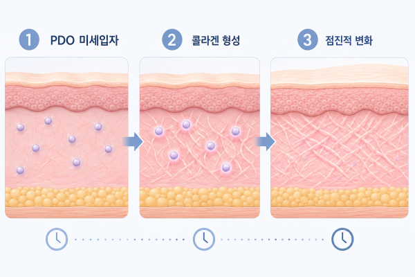 PDO 미세입자 주입 콜라겐 형성 점진적 피부 변화 3단계 과정