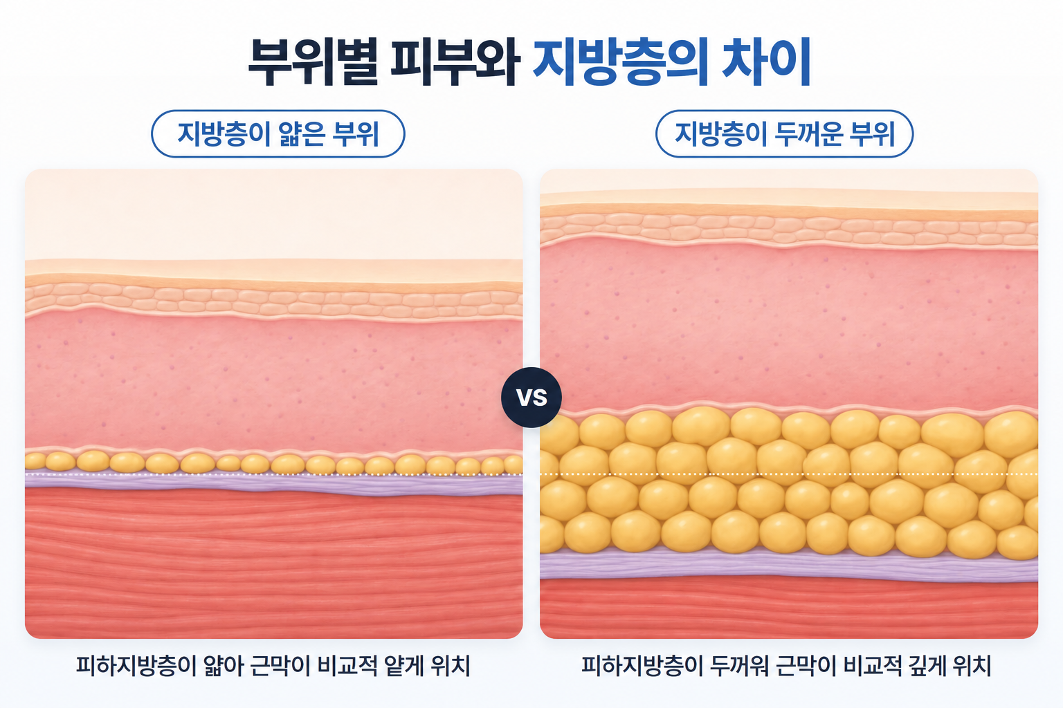 피하지방층이 얇은 부위와 두꺼운 부위에서 나타나는 근막 위치 차이