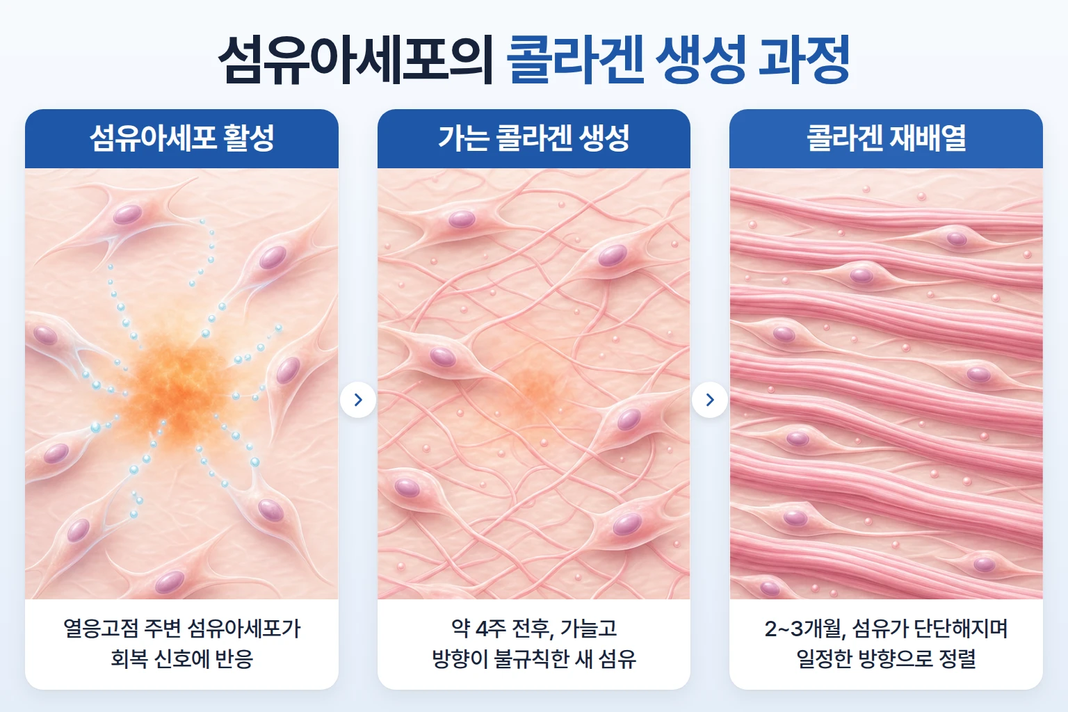 열응고점 주변 섬유아세포가 활성화되어 콜라겐 섬유를 만들고 정렬하는 과정을 단계별로 그린 개념도