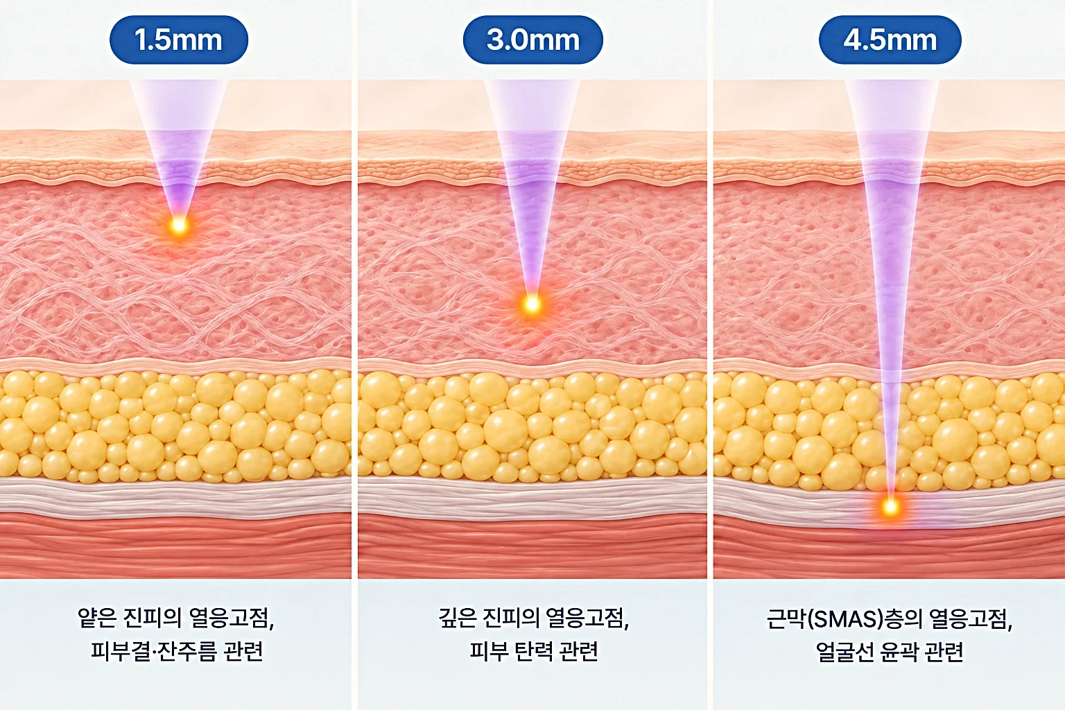 1.5mm, 3.0mm, 4.5mm 깊이에 초음파 열응고점이 맺히는 위치를 층별로 비교한 단면도