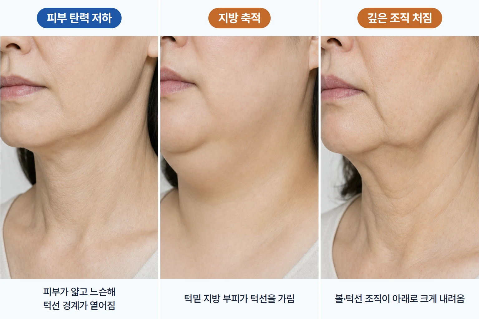 피부 탄력 저하, 지방 축적, 깊은 조직 처짐에 따른 하관 윤곽 차이를 나란히 보여준 비교 사진