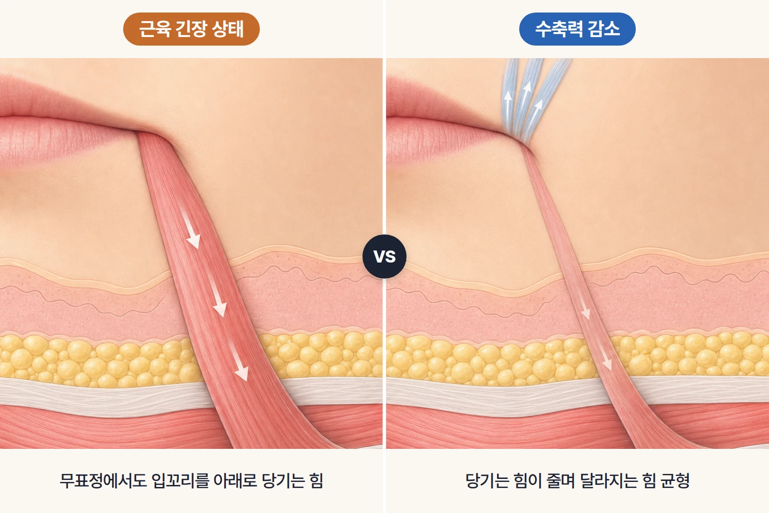 입꼬리를 아래로 당기는 근육의 위치와 수축 방향, 힘 균형 변화를 비교한 근육 모식도