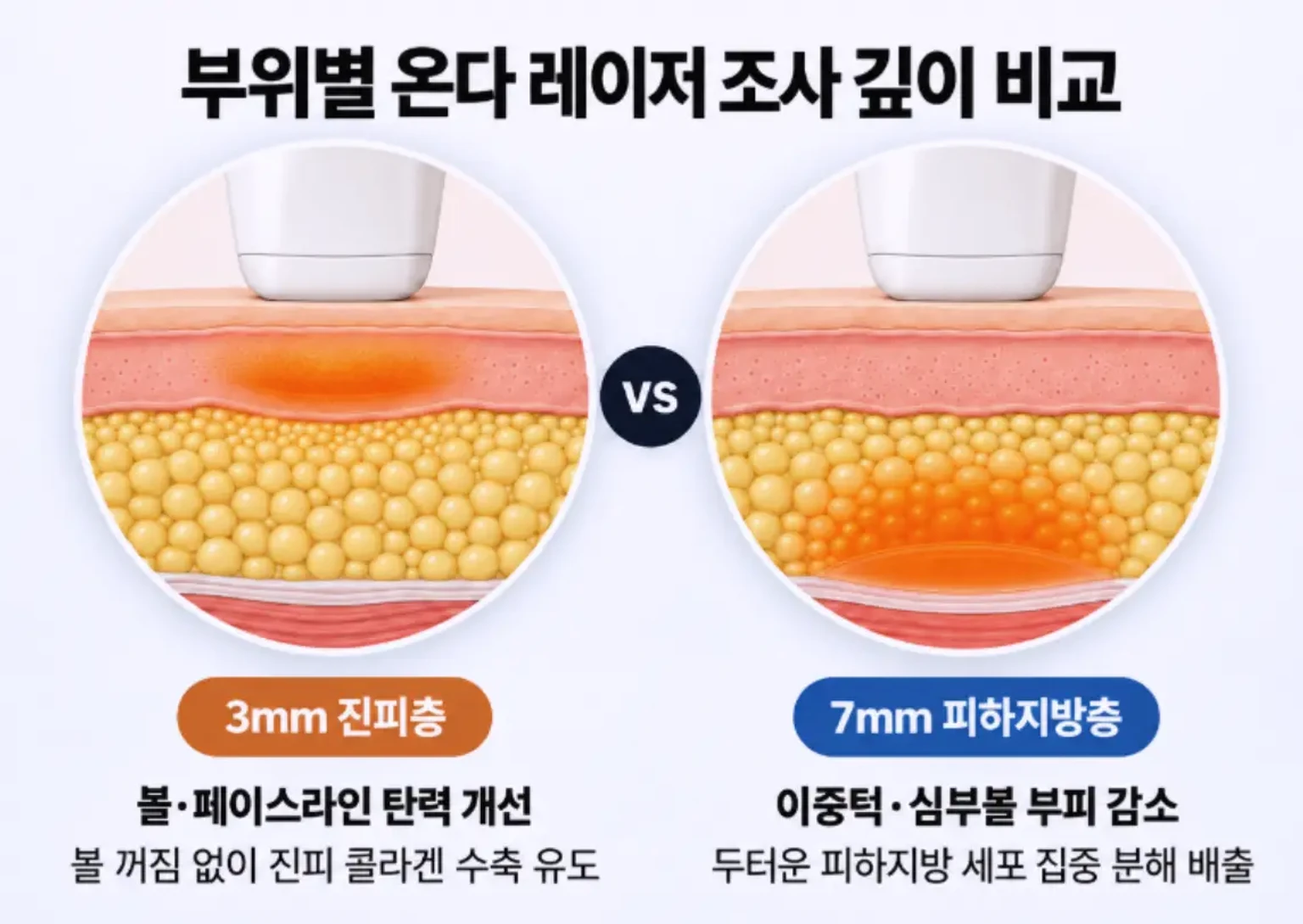 볼 탄력 개선을 위한 3mm 진피층 타깃과 이중턱 지방 분해를 위한 7mm 피하지방층 타깃의 온다 레이저 깊이 비교 모식도