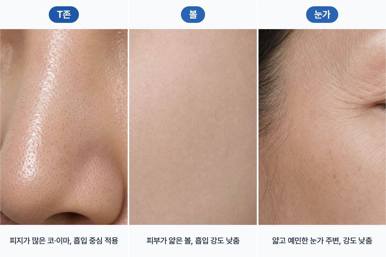 피지가 많은 T존 코, 피부가 얇은 볼과 눈가를 나눠 보여준 아쿠아필 부위별 강도 비교 사진