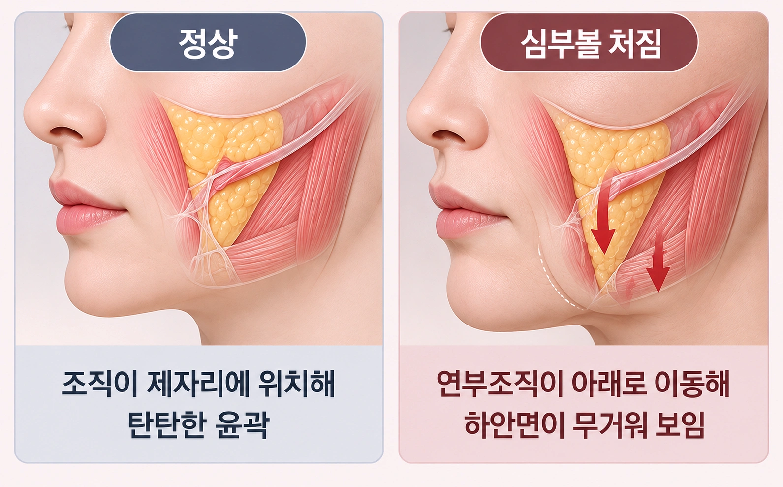 정상 상태와 비교해 살펴보는 심부볼 처짐의 구조적 변화