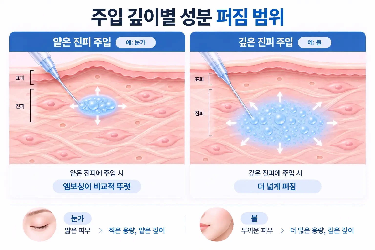 같은 성분을 얕은 진피와 깊은 진피에 주입했을 때 퍼지는 범위를 비교한 주입 깊이 모식도