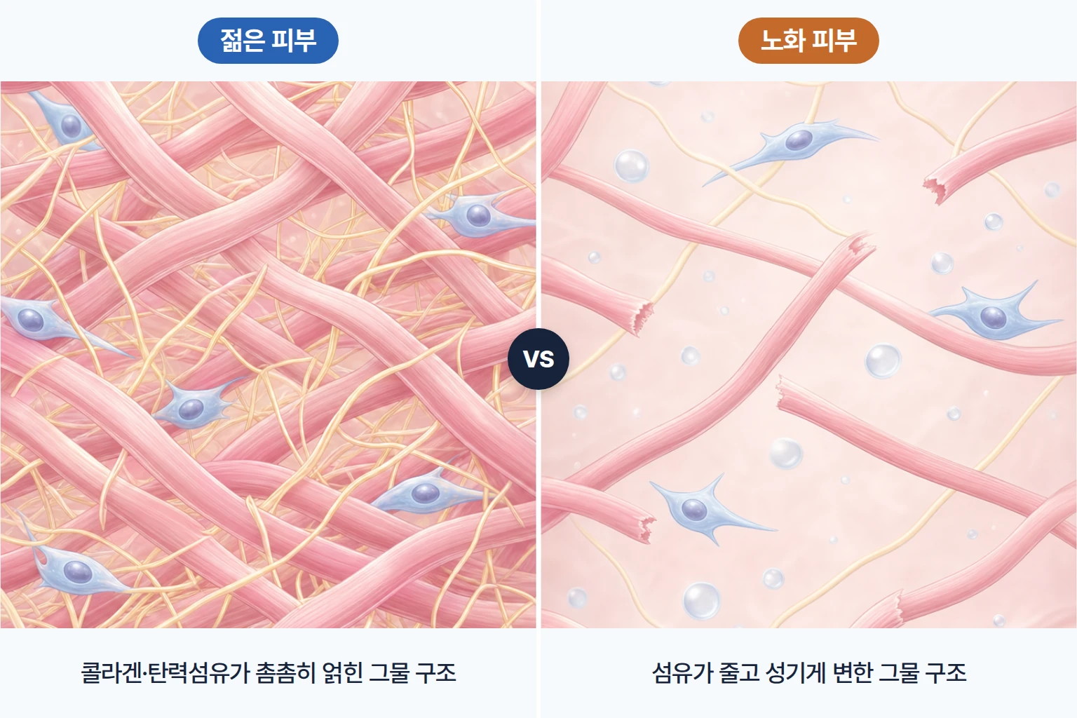 젊은 피부와 노화 피부의 콜라겐 탄력섬유 구조 차이