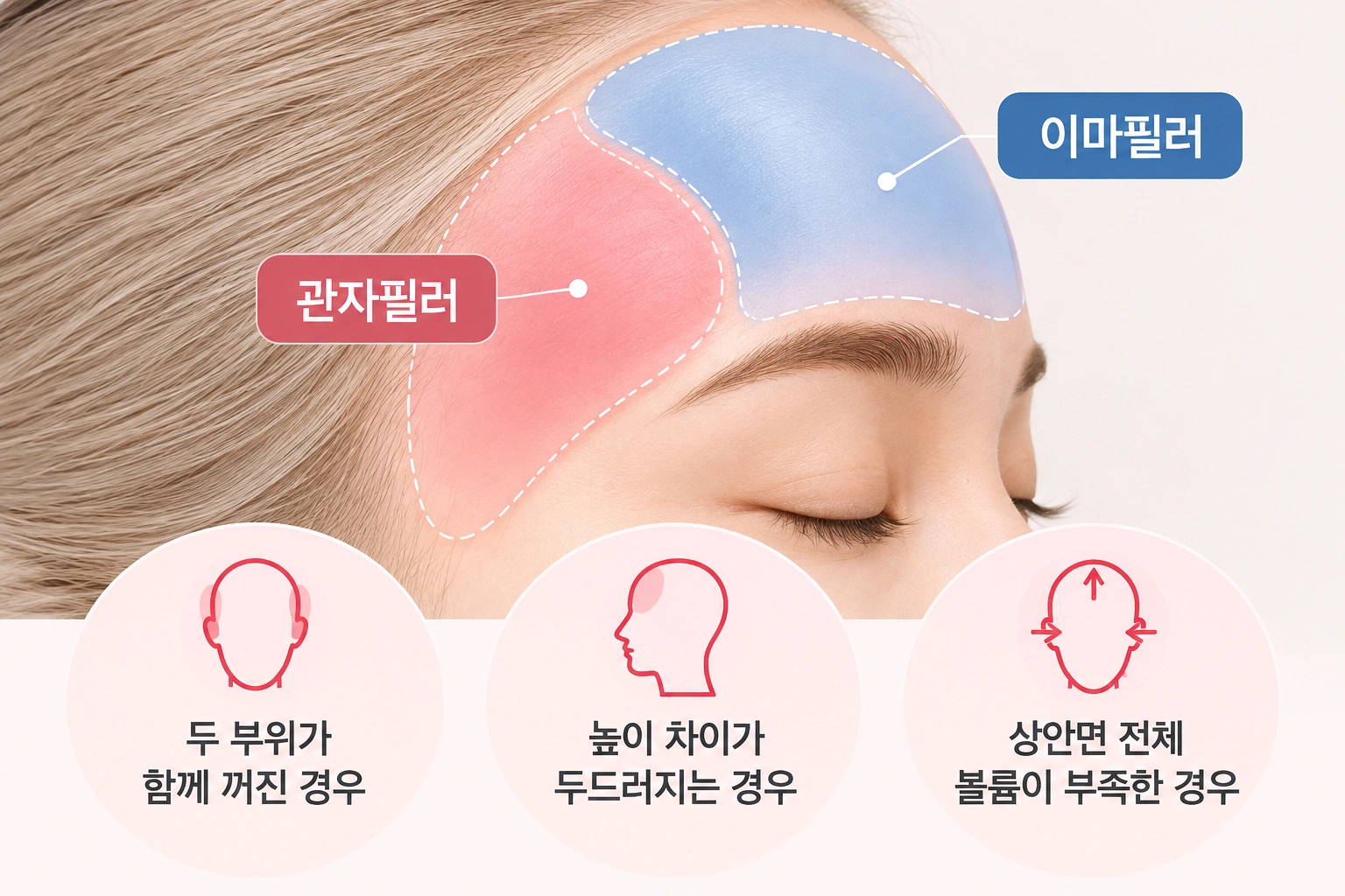 관자필러와 이마필러의 주입 부위 및 얼굴 윤곽 개선 범위를 비교한 인포그래픽