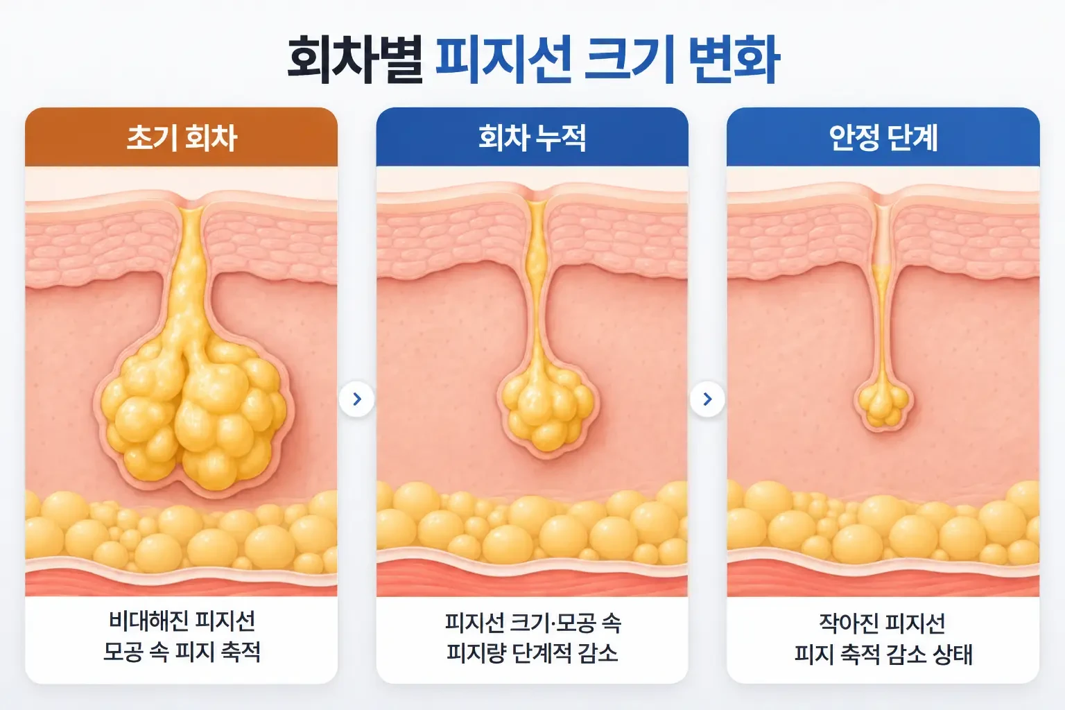 회차가 쌓이며 비대한 피지선 크기와 모공 속 피지량이 줄어드는 변화를 단계별로 그린 피부 단면도