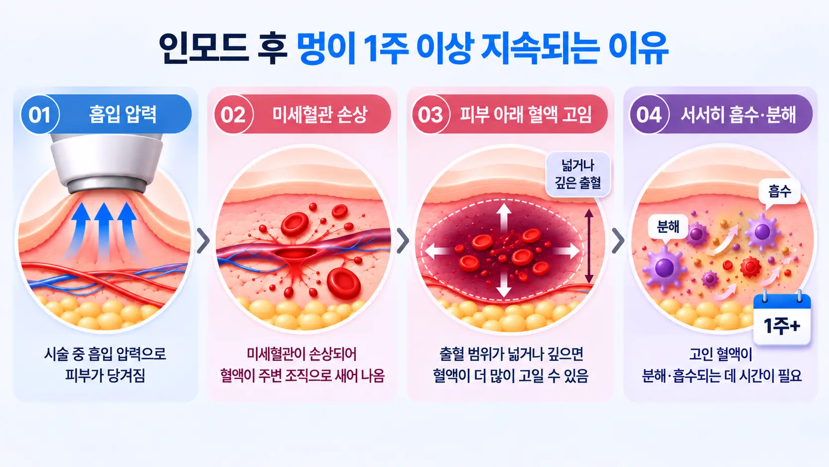 인모드 멍 기간이 1주 이상 지속되는 이유를 피부 아래 출혈 범위와 혈액의 분해·흡수 과정으로 설명한 일러스트